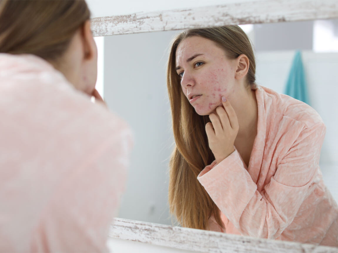 femeie - piele predispusă la acnee 