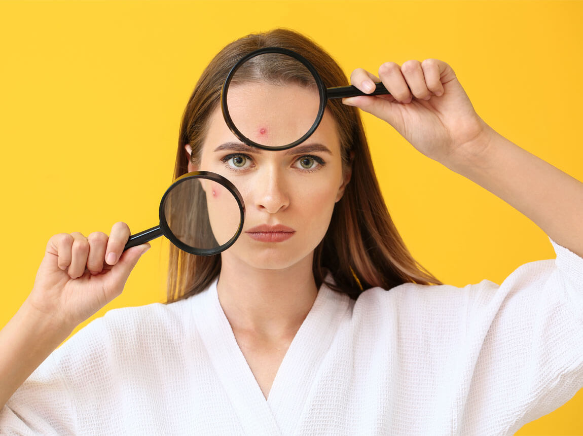 femeie - piele predispusă la acnee 