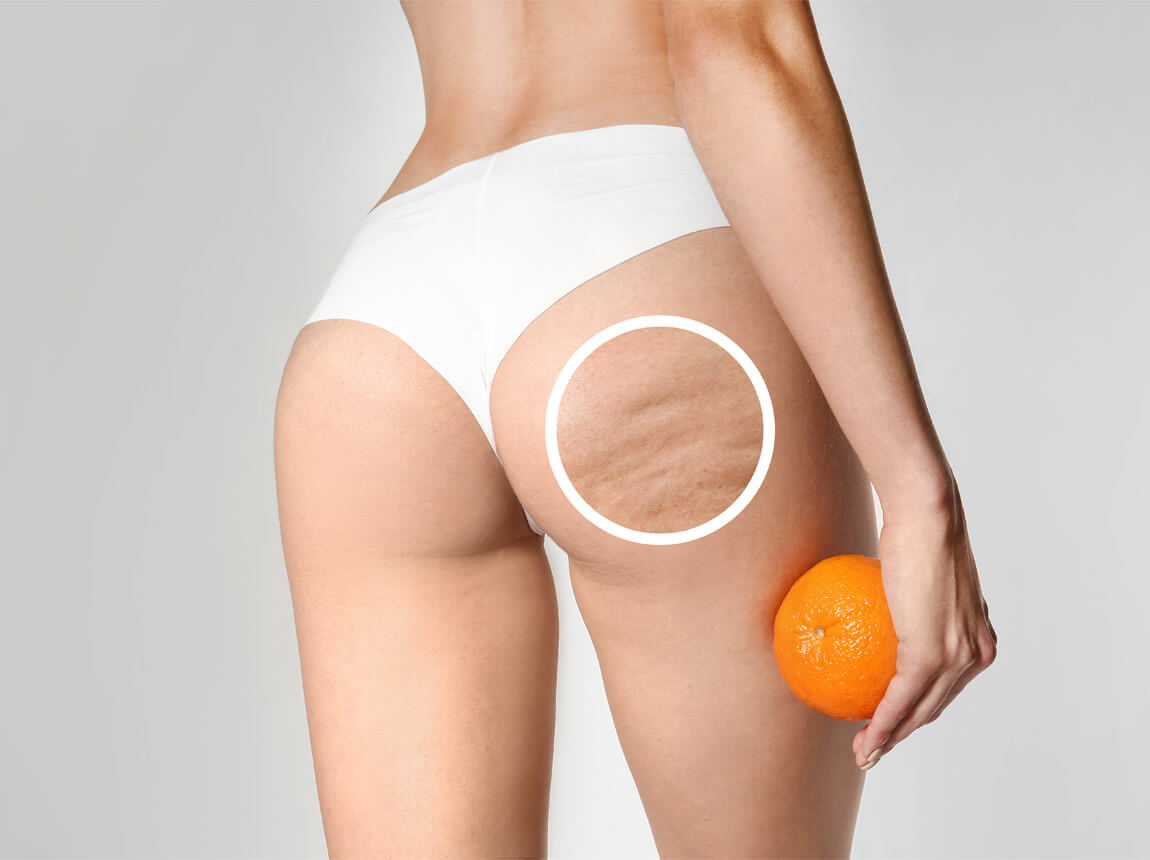 celulită pe picioare 