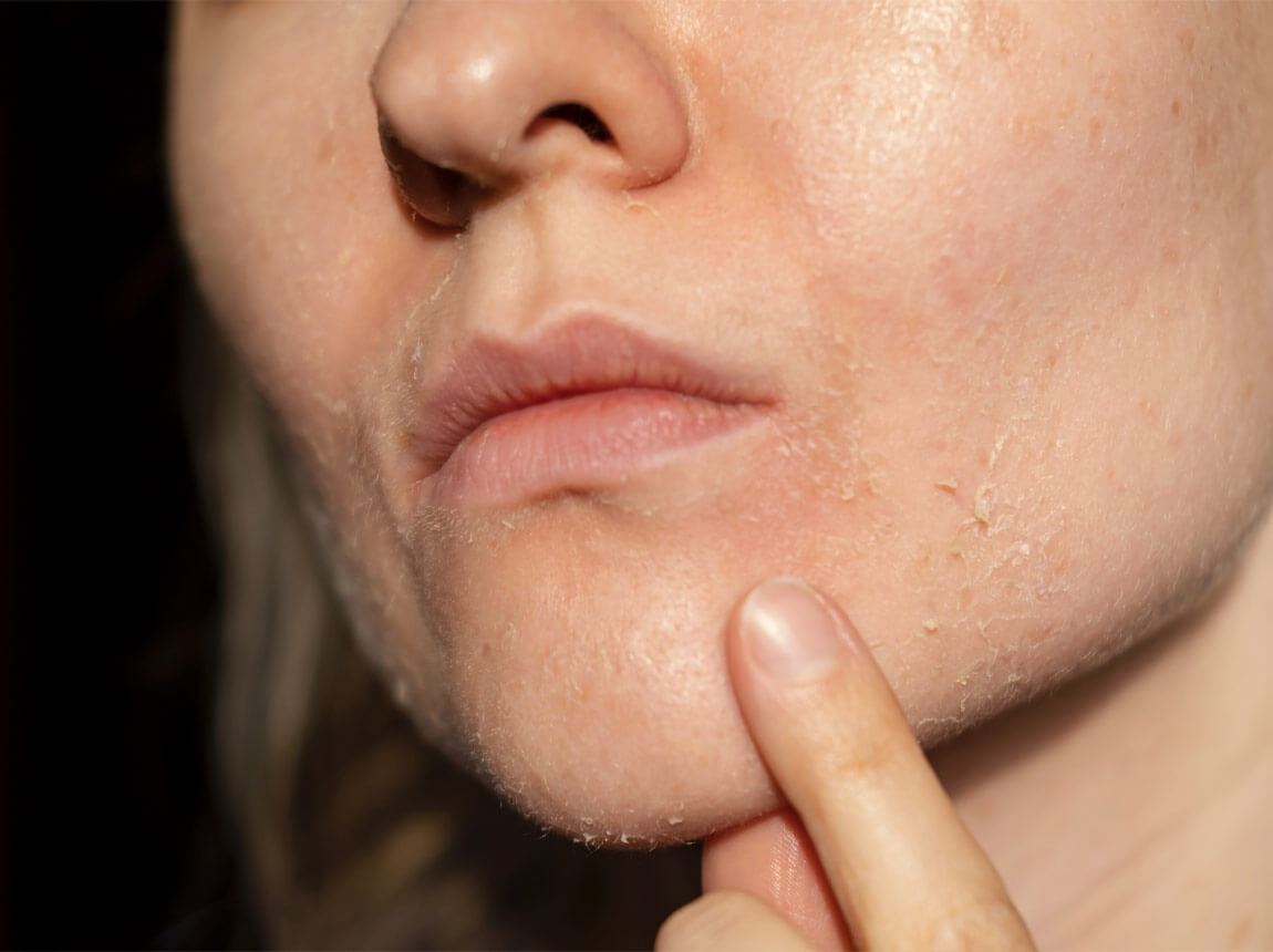 femeie - piele uscată 