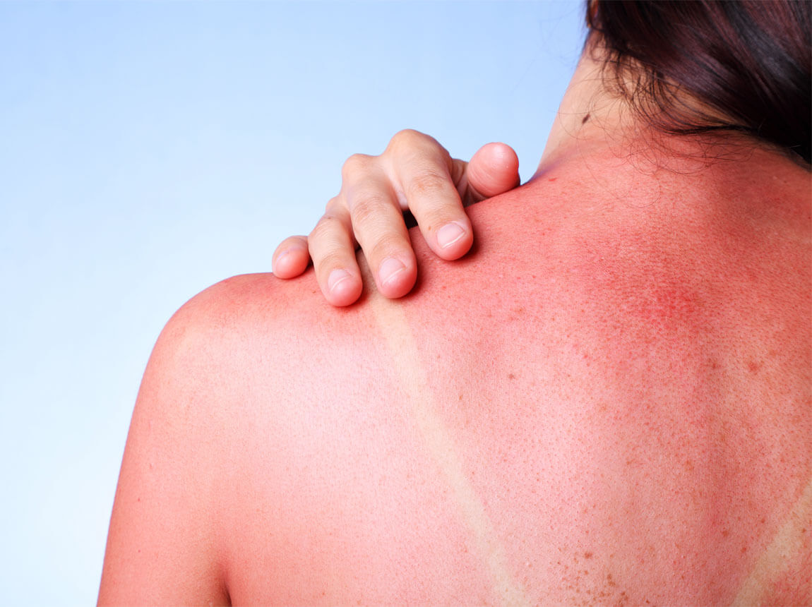 Arsuri după expunerea la soare