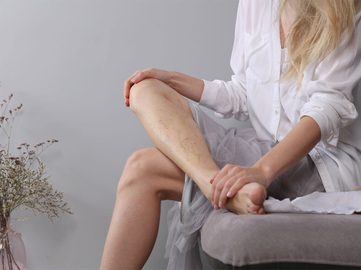 femeie - vene varicoase pe picioare 