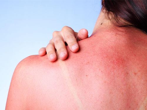 Care sunt remediile casnice pentru arsurile solare?