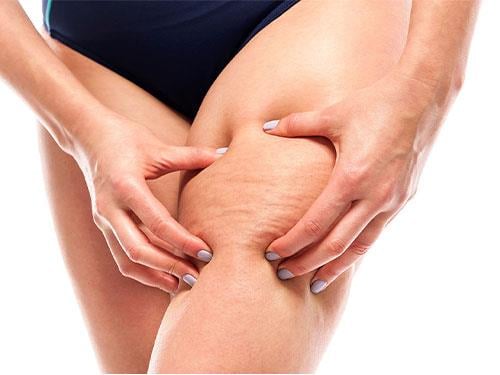 Cafeina poate ajuta la combaterea celulitei?