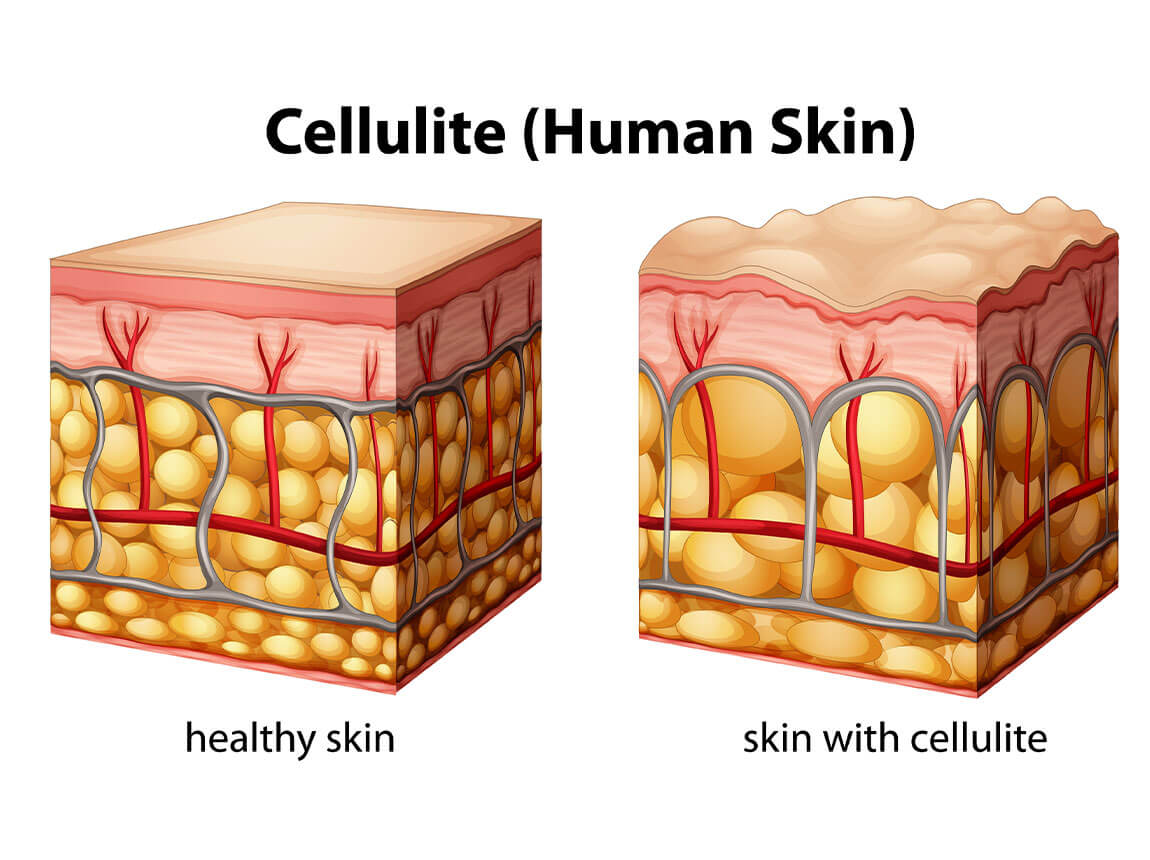 celulită și piele fără celulită